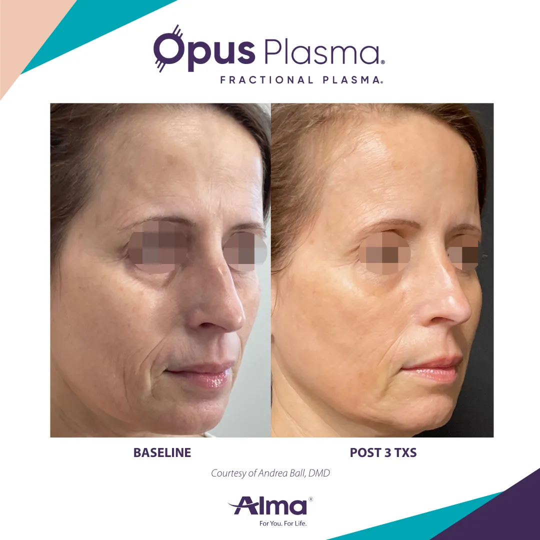 opus skin resurfacing