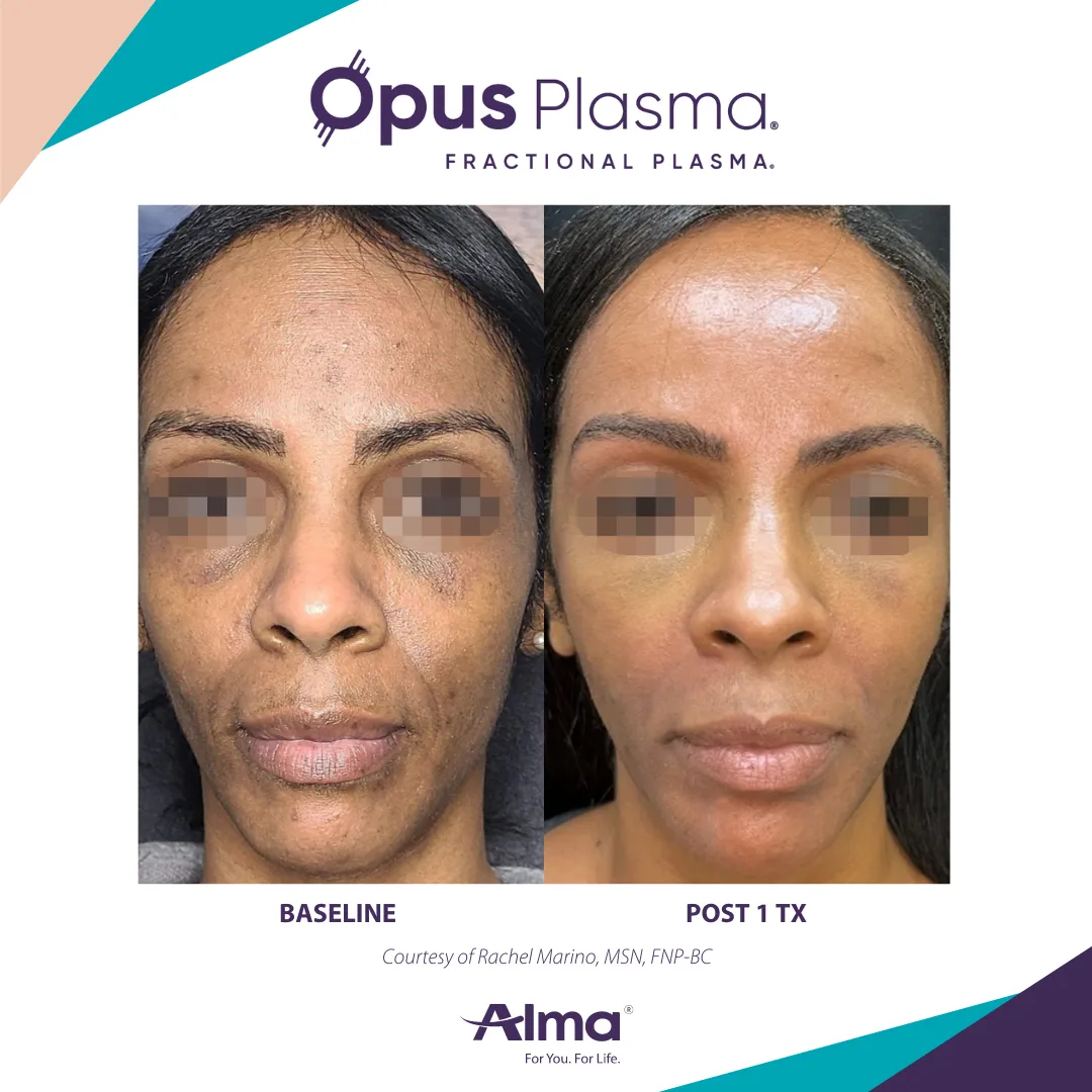 opus skin rejuvenation